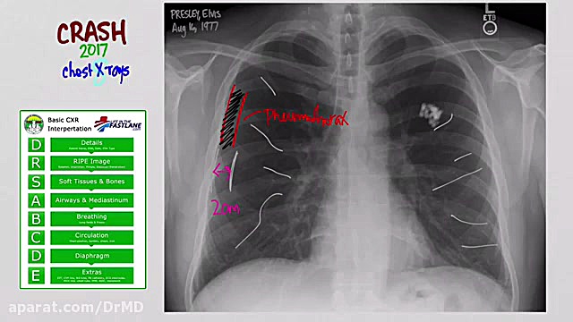 آموزش خواندن گرافی قفسه سینه CXR دکتر مهدی صادقی