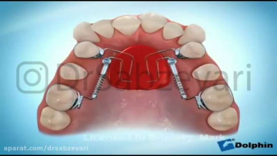 دستگاه ارتودنسی در فک بالا برای ایجاد فضا دکتر برهمن سبزواری - متخصص ارتودنسی - مشهد
