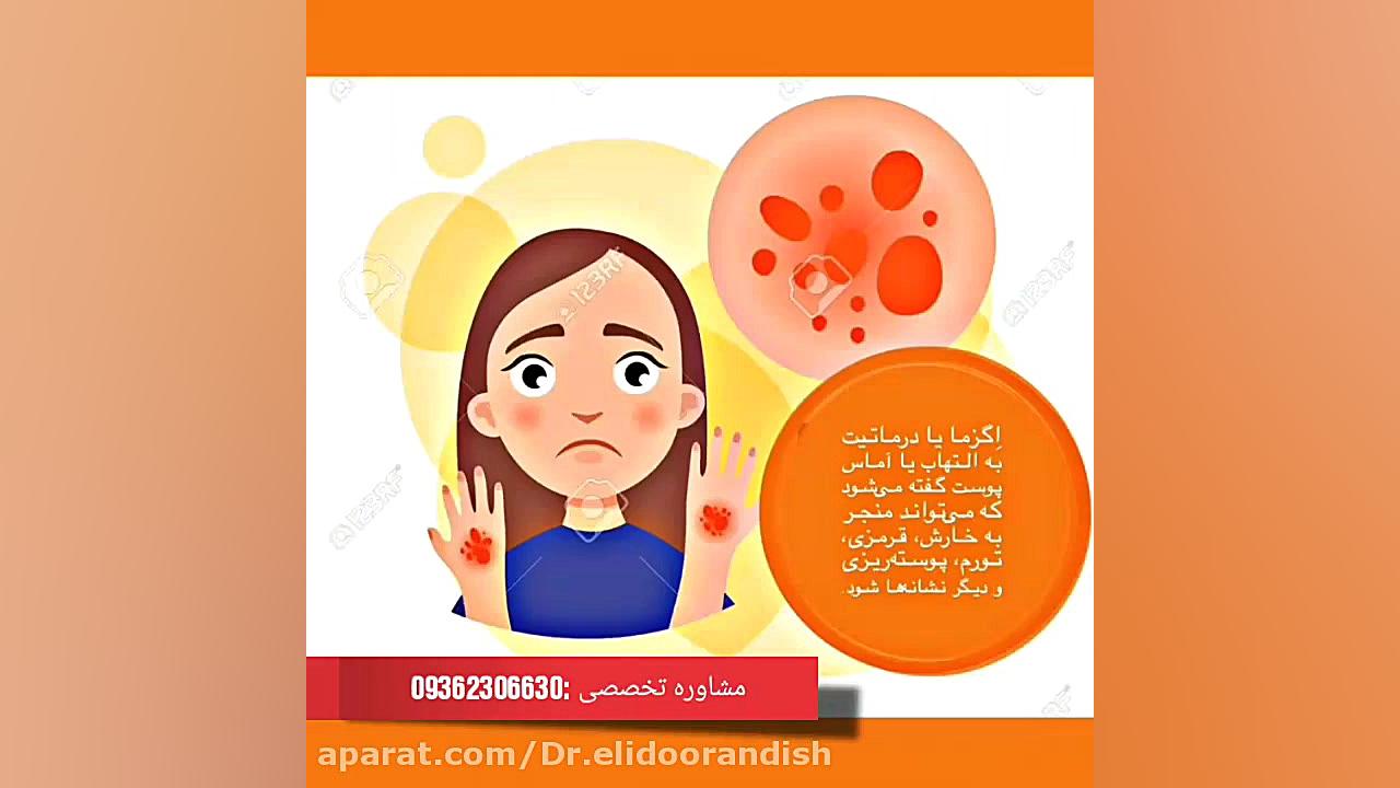 رابطه مستقیم اگزما با سرطان پوست مصطفی زمانی