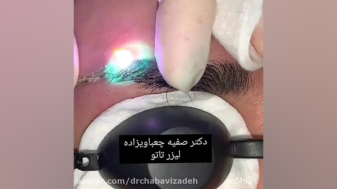 پاک کردن خالکوبی با لیزر دکتر صفیه چعباوی زاده