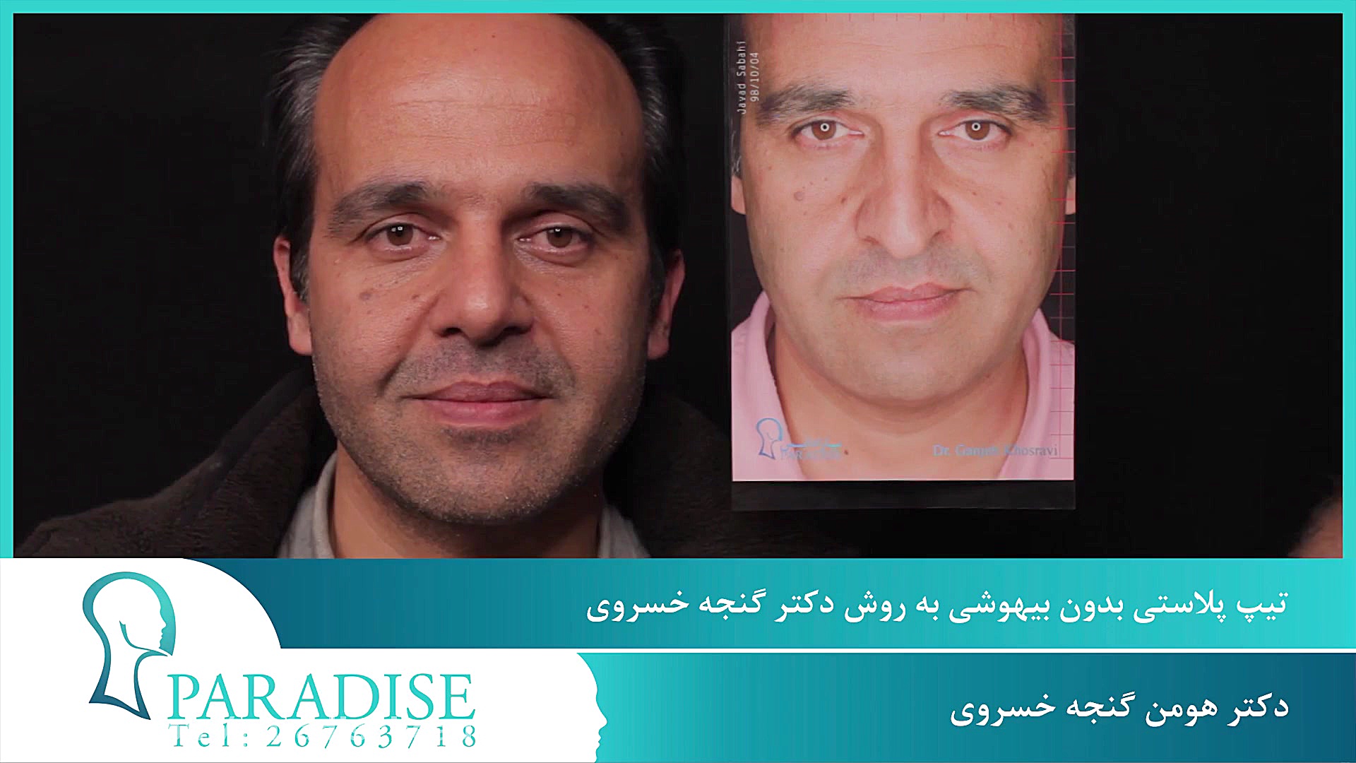 تیپ پلاستی عمل زیبایی بینی بدون بیهوشی ترمیم دندان