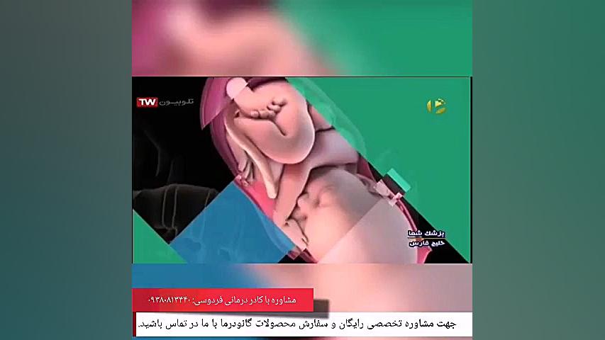 چه زمانی شخص به کمکاری تیروئید مبتلا می‌شود؟ عصب‌کشی