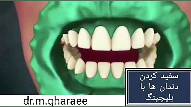 سفید کردن دندان با بلیچینگ دکتر مریم قرایی