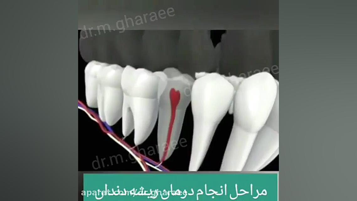 مراحل درمان ریشه دندان دکتر مریم قرایی