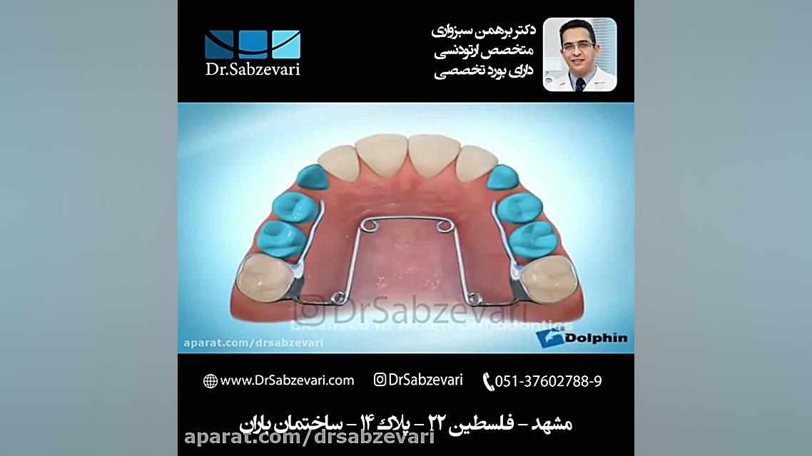 گسترش عرضی فک بالا در ارتودنسی دکتر برهمن سبزواری - متخصص ارتودنسی - مشهد
