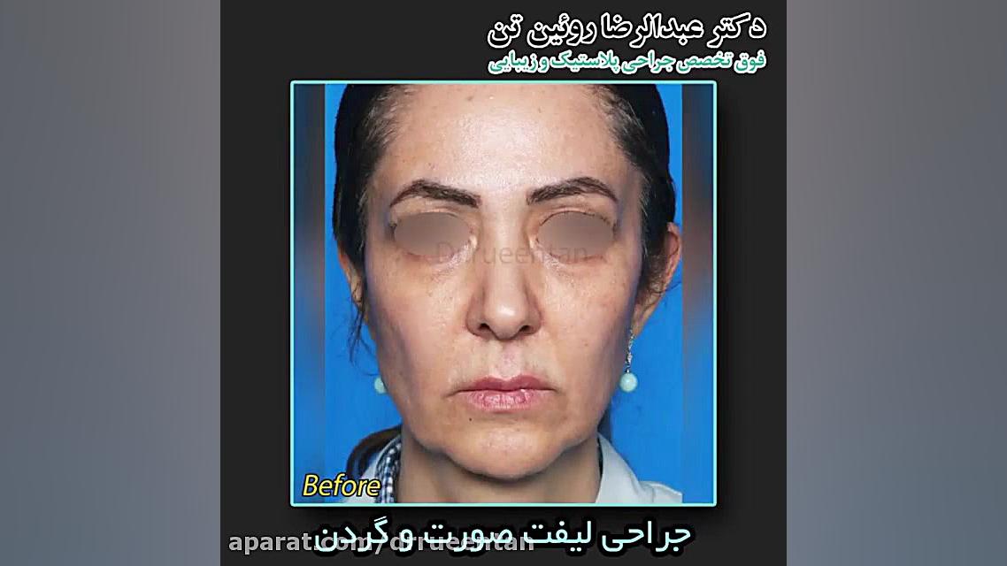 جراحی لیفت صورت و گردن دکتر عبدالرضا روئین تن