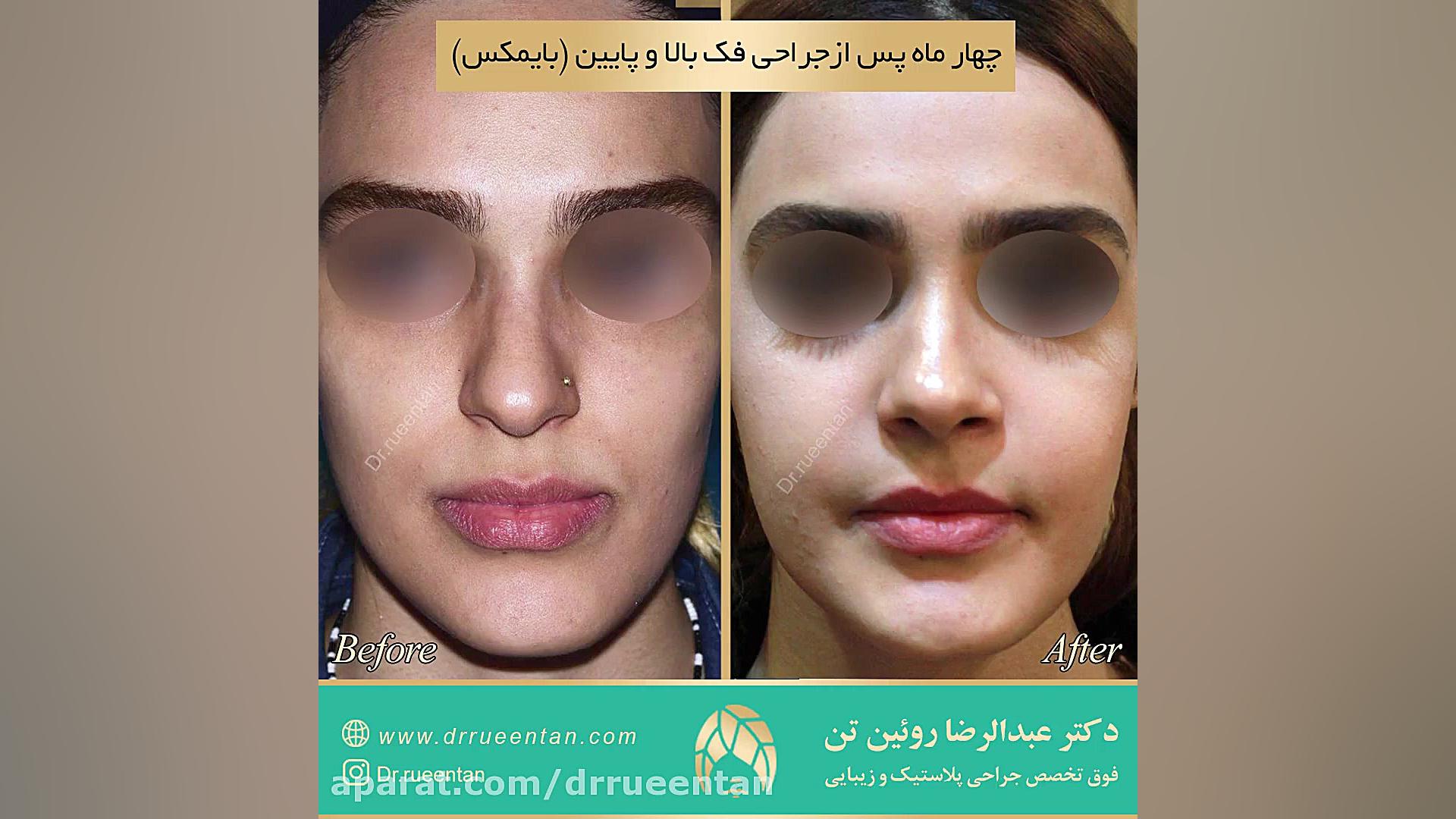 جراحی فک بالا و پایین ریژنراتیو مدیسین