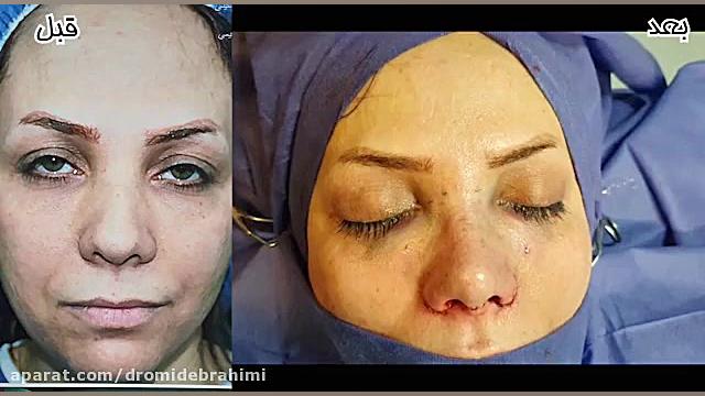 عمل بینی گوشتی قوزدار توسط دکتر امید ابراهیمی بهترین جراح بینی گوشتی دکتر امید ابراهیمی