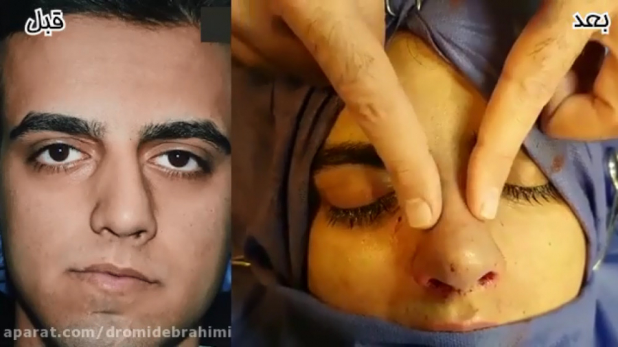 اصلاح کجی بینی قوزدار توسط بهترین جراح بینی، دکتر امید ابراهیمی دکتر امید ابراهیمی