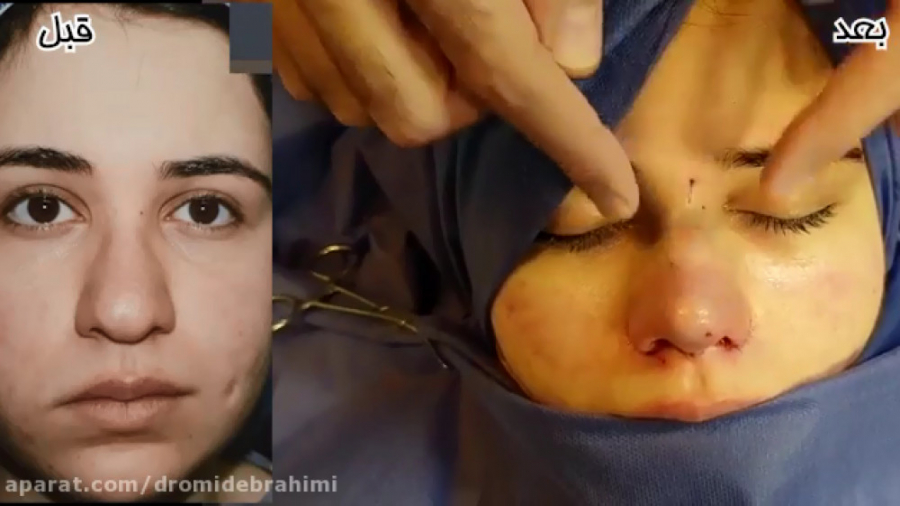 عمل بینی گوشتی توسط بهترین جراح بینی دکتر امید ابراهیمی دکتر امید ابراهیمی