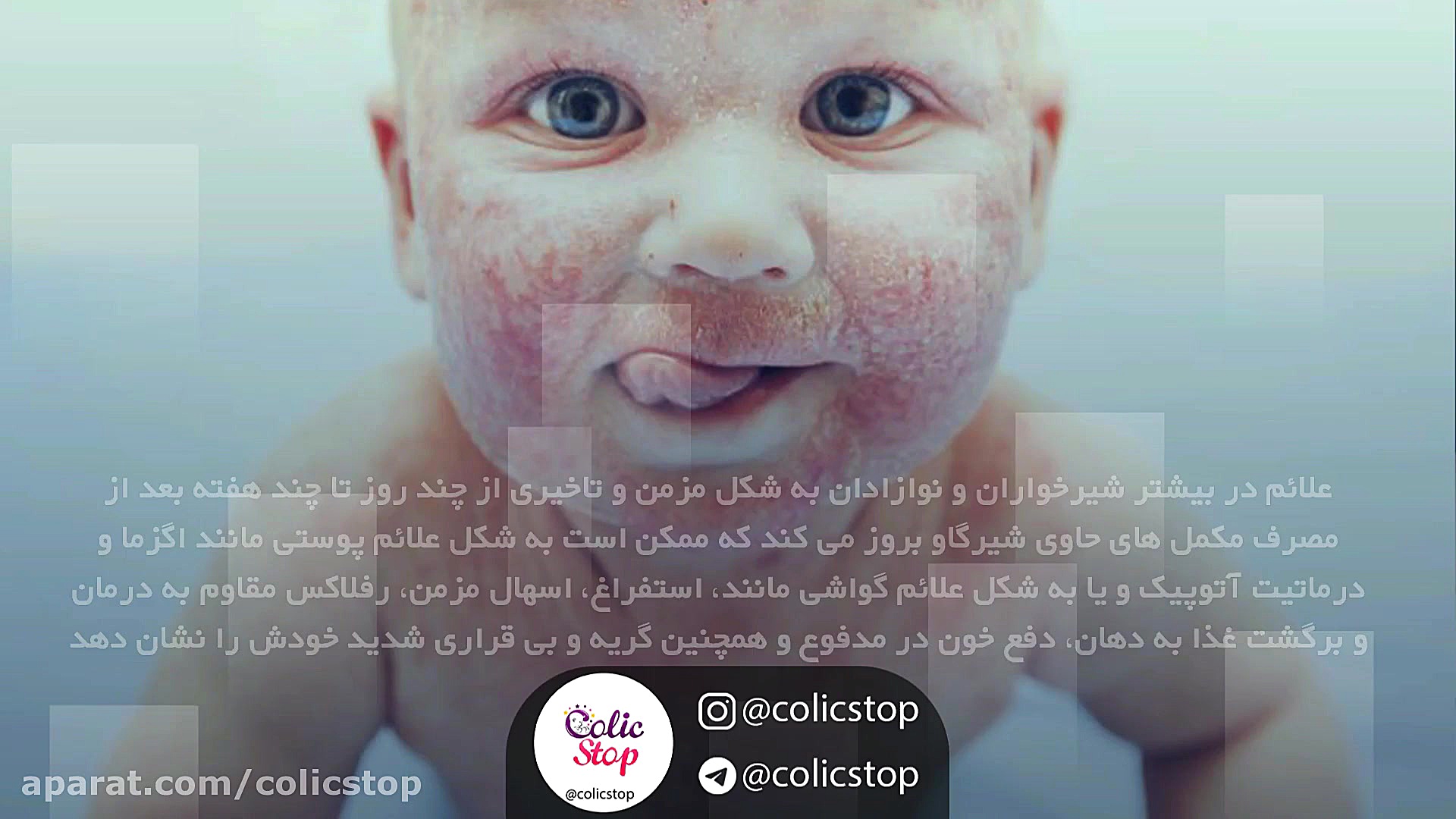 علائم حساسیت به پروتئین گاوی بلاگر هپروتی