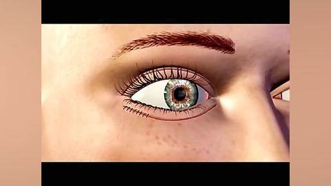 eyelid surgery animation by dr.emami دکتر علیرضا امامی