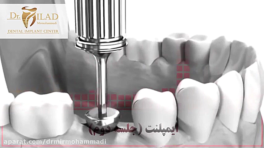 ایمپلنت دندان در جلسه دوم آنیسکوری