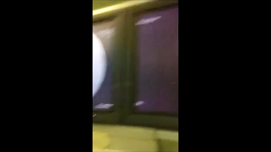 درمان تنگی و چسبندگی کانال نخاع دکتر بابک اشرف نژاد
