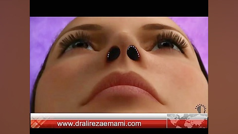 Rhinoplasty surgery animation by dr.emami دکتر علیرضا امامی