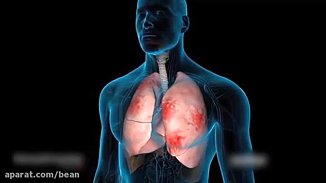 ذات الریه.. بیماری خطرناک رفع غبغب