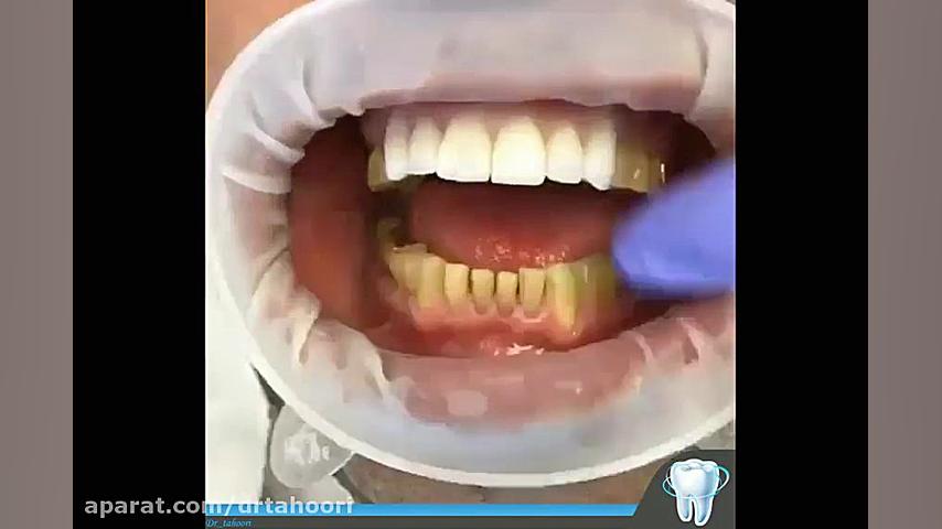 روکش دندان-مرکز دندانپزشکی فوق تخصصی ایمپلنت پردیس www.pardisdental.ir ویروس‌شناسی پیشرفته