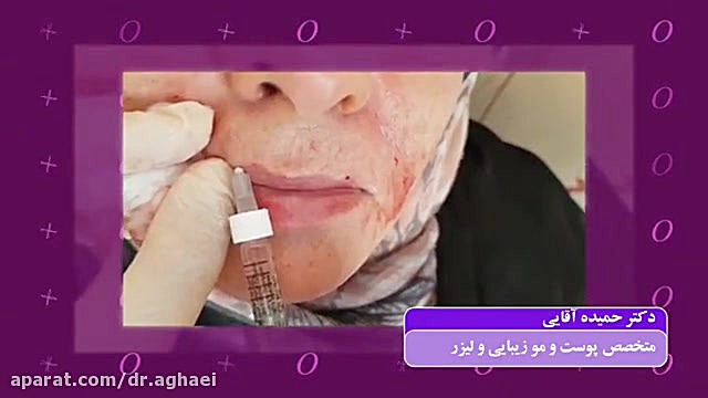 فیلم تزریق ژل لب دکتر حمیده آقایی