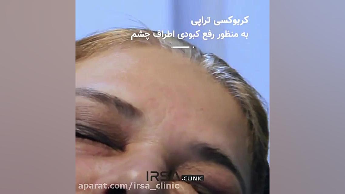کربوکسی تراپی به منظور رفع تیرگی دور چشم پالپوتومی