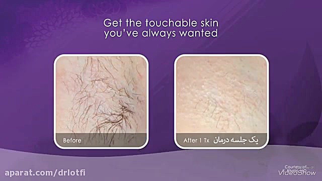 لیزر الکساندرایت و کاربرد آن در رفع موهای زائد دکتر سار ا لطفی