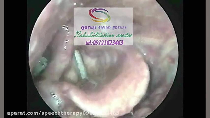 بررسی مشکلات اختلال بلع |گفتار توان گستر 09121623463 اصلاح فرم صورت