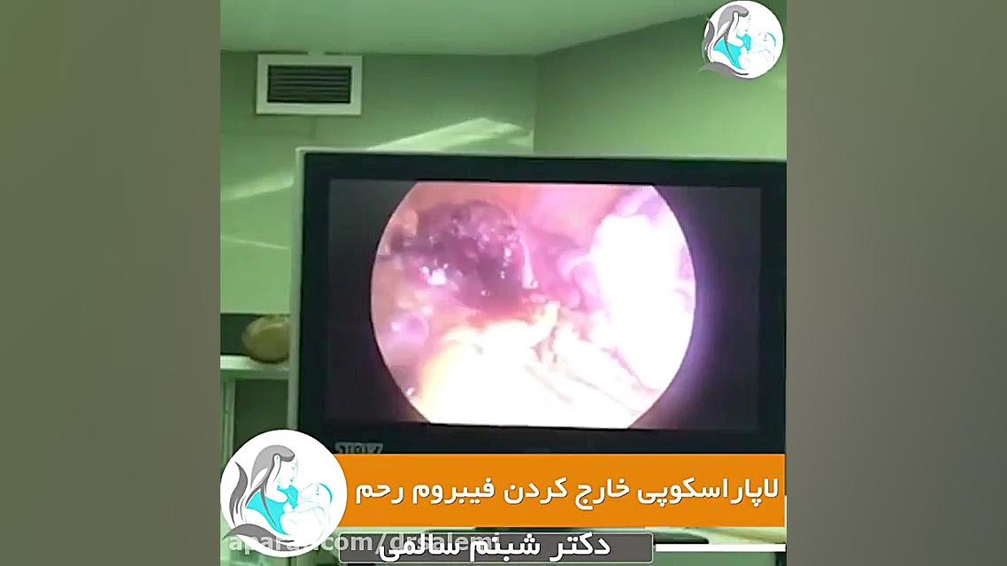 عمل لاپاراسکوپی خارج کردن فیبروم رحم هایفوتراپی