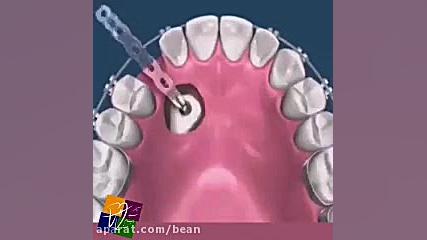 حرکت دندان نیش نهفته داخل فک به سمت قوس دندانى بلیچینگ دندان
