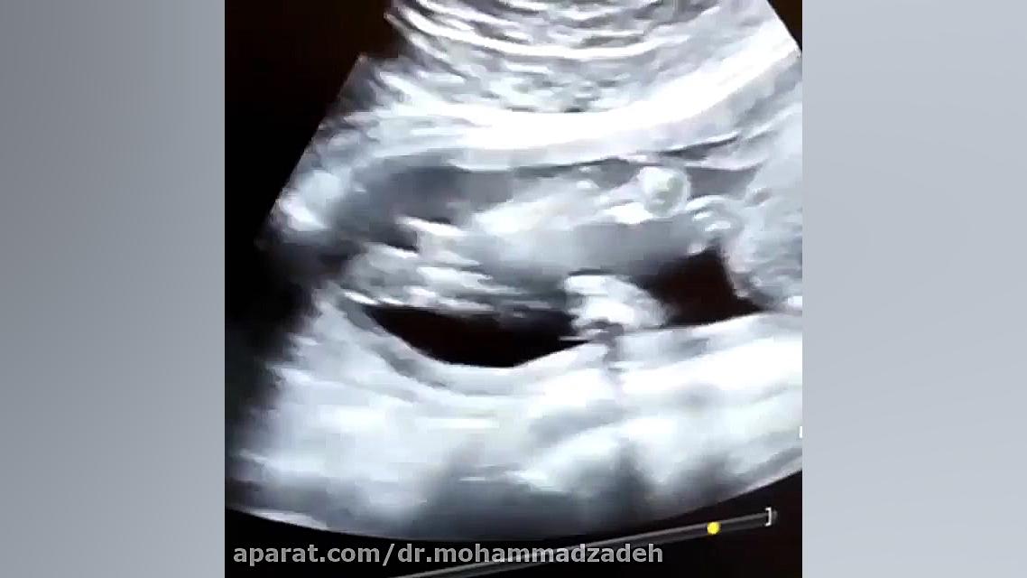 فیلم سونوگرافی صورت جنین دست و پا چلفتی
