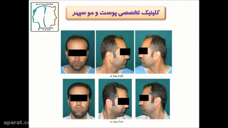 کدام روش کاشت مو برای من بهتر است؟ دکتر علی وفائی - متخصص پوست و مو