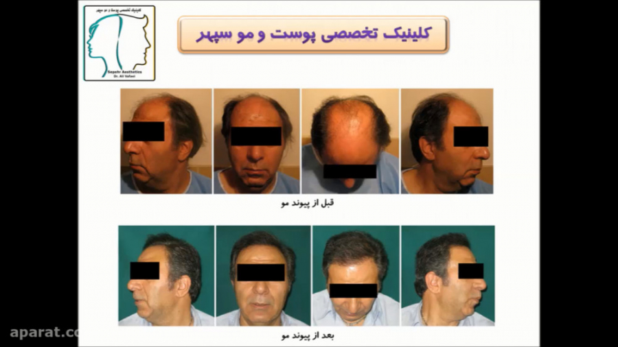 ریزش مو بعد از کاشت مو دکتر علی وفائی - متخصص پوست و مو