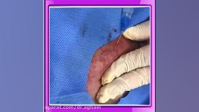 فیلم سابسیژن دکتر حمیده آقایی