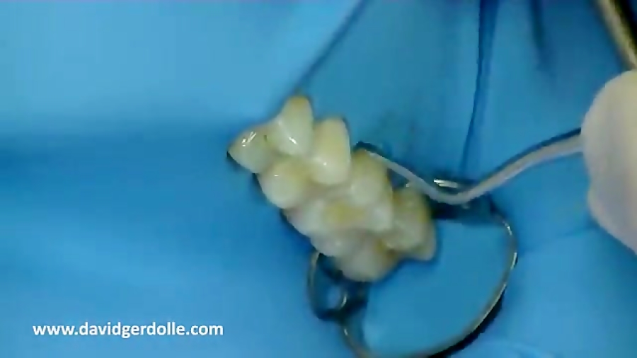 پوستریور دندان (posterior) دکتر سهیل سالاری