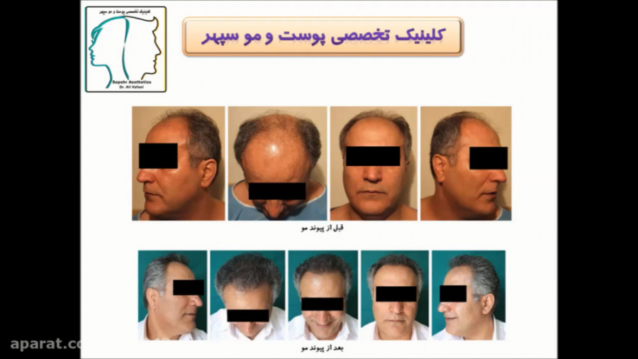 خط موی جلوی سر در کاشت موی طبیعی دکتر علی وفائی - متخصص پوست و مو