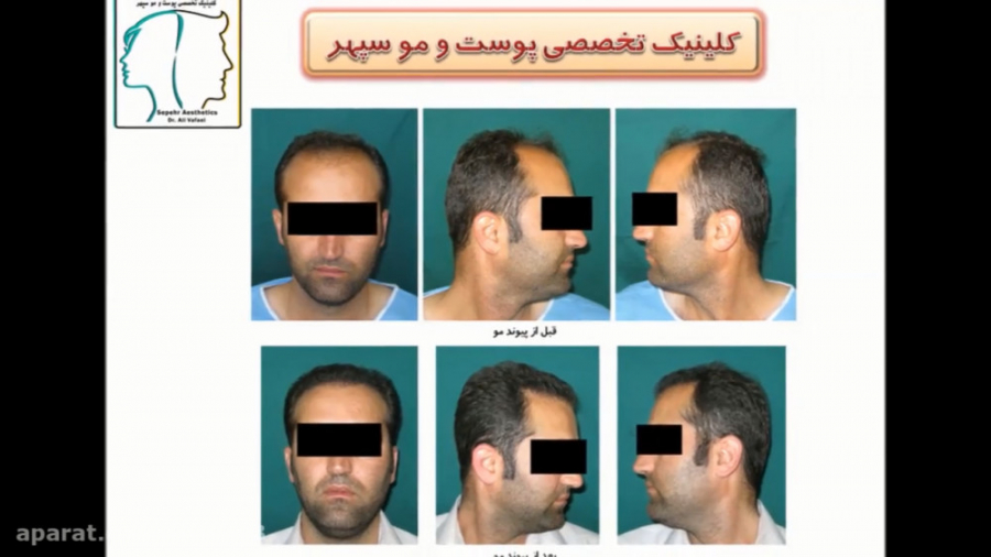 داروهای کاشت موی طبیعی دکتر علی وفائی - متخصص پوست و مو