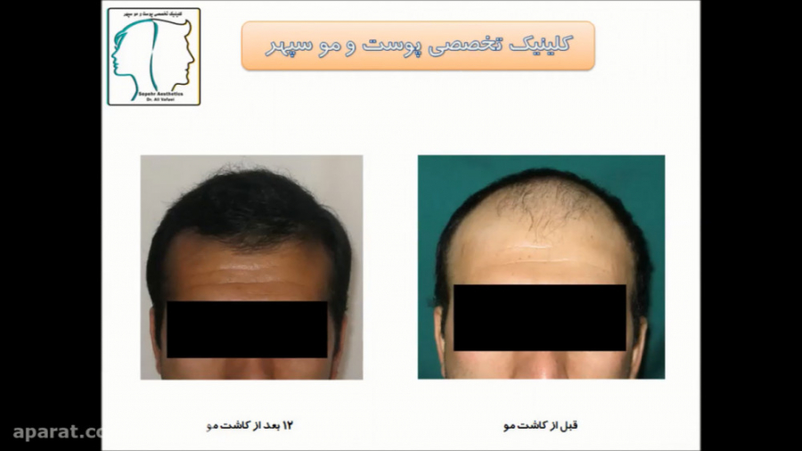 سیر وقایع در کاشت موی طبیعی دکتر علی وفائی - متخصص پوست و مو