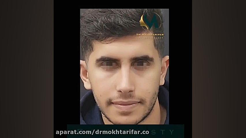 چهار ماه بعد از جراحی زیبایی بینی دکتر فاطمه مختاری فر جراح بینی در لرستان