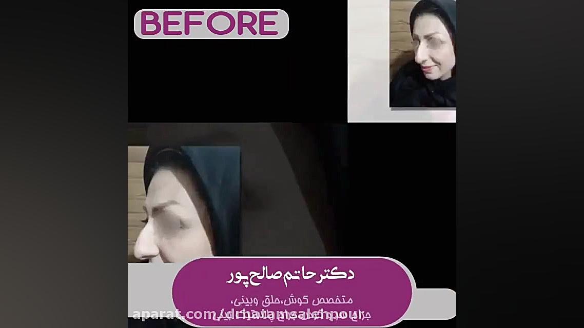 نمونه جراحی بینی (دو هفته بعد از عمل) کامپوزیت ونیر