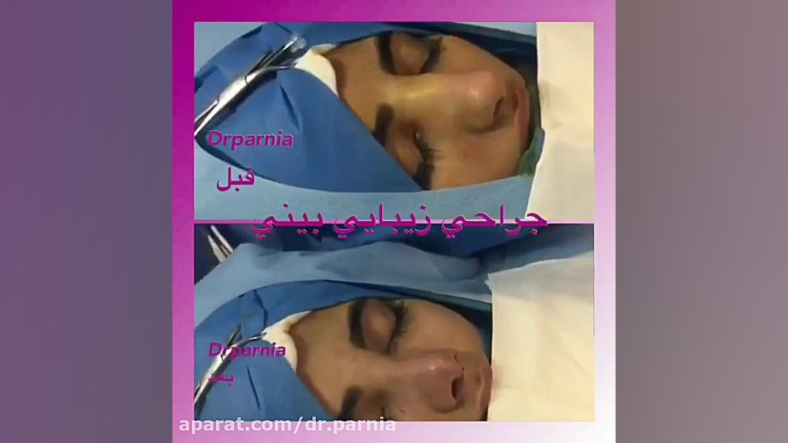جراحی زیبایی بینی دکتر رفیع پرنیا فوق تخصص پلاستیک