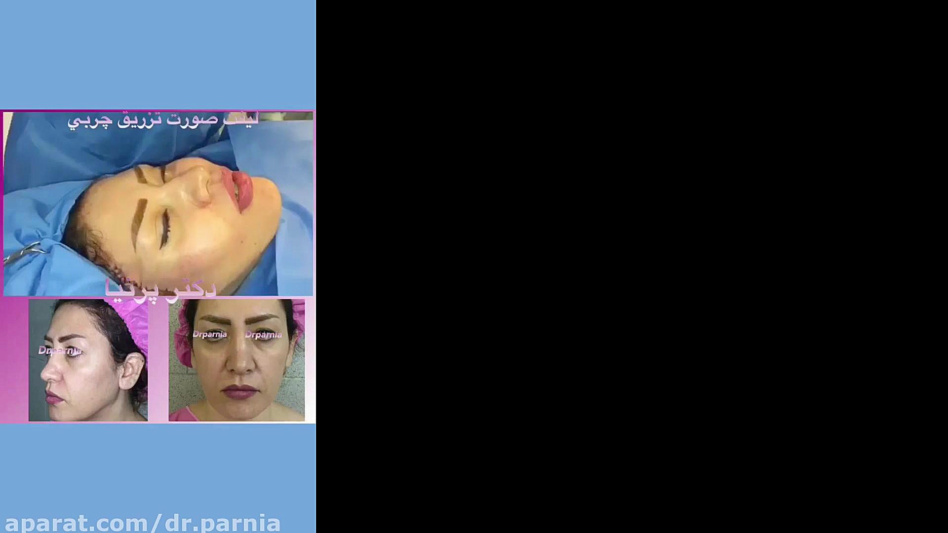 جراحی لیفت صورت دکتر رفیع پرنیا فوق تخصص پلاستیک