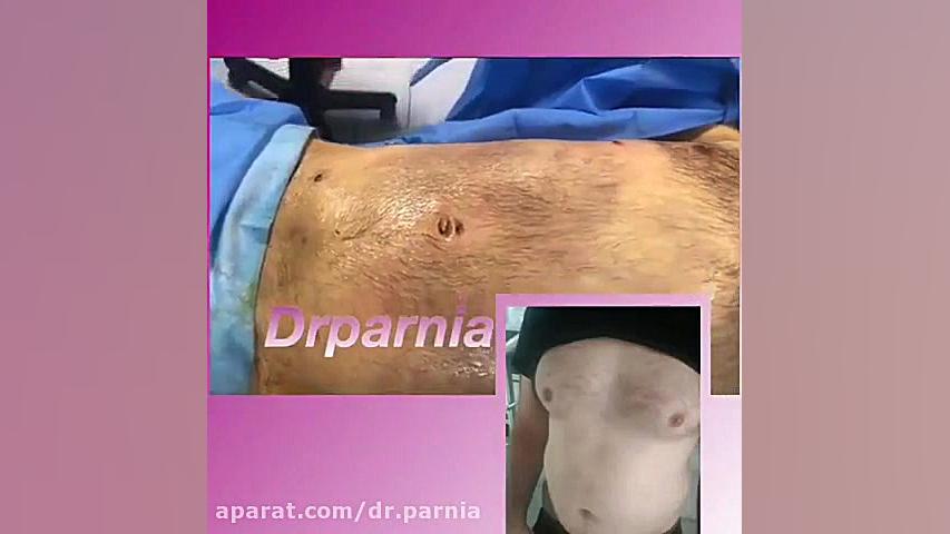 عمل ژنیکوماستی دکتر رفیع پرنیا فوق تخصص پلاستیک