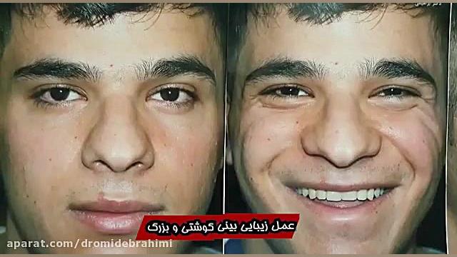 جراحی بینی گوشتی پهن و بزرگ توسط دکتر امید ابراهیمی بهترین جراح بینی تهران دکتر امید ابراهیمی