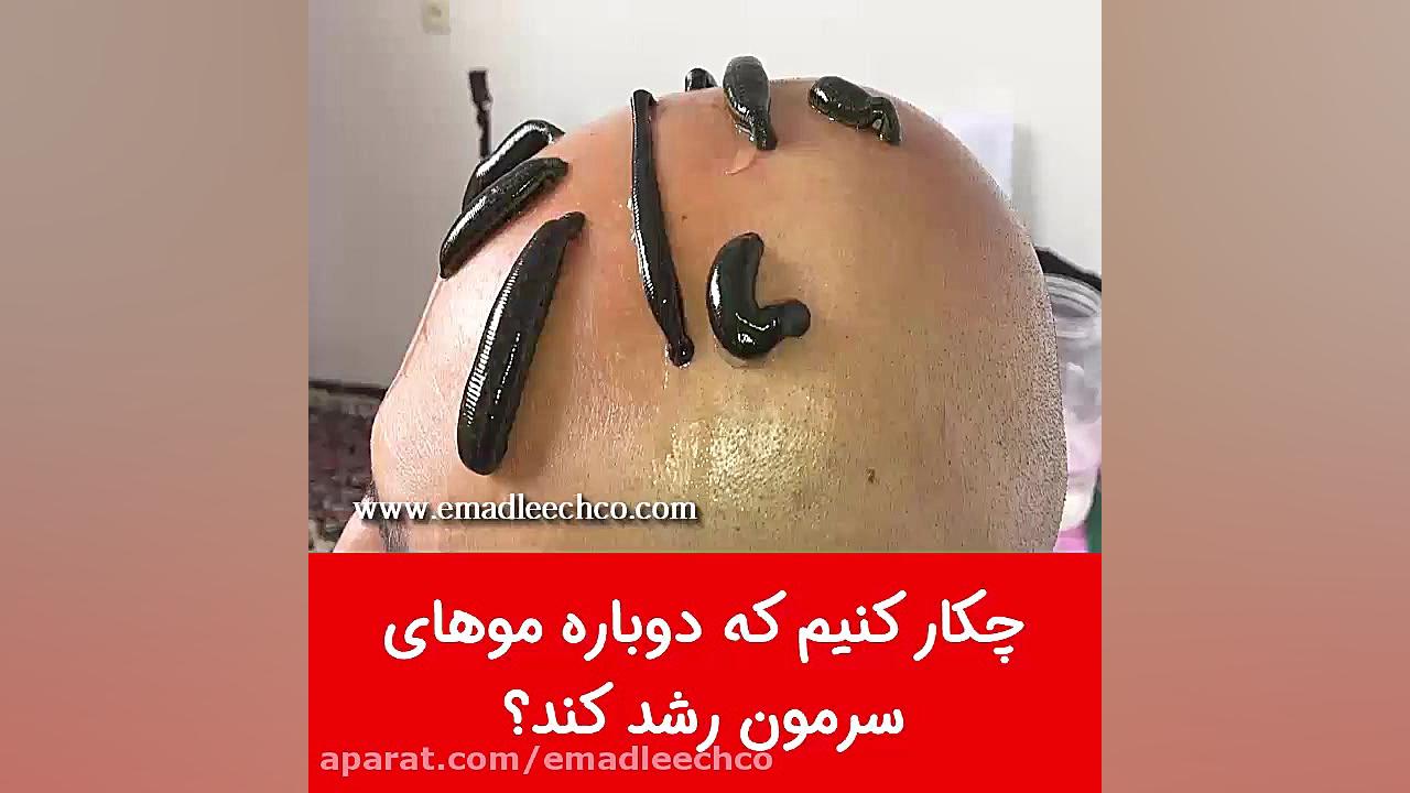 چکار کنیم که دوباره موهای سرمون رشد کند؟ ارتودنسی