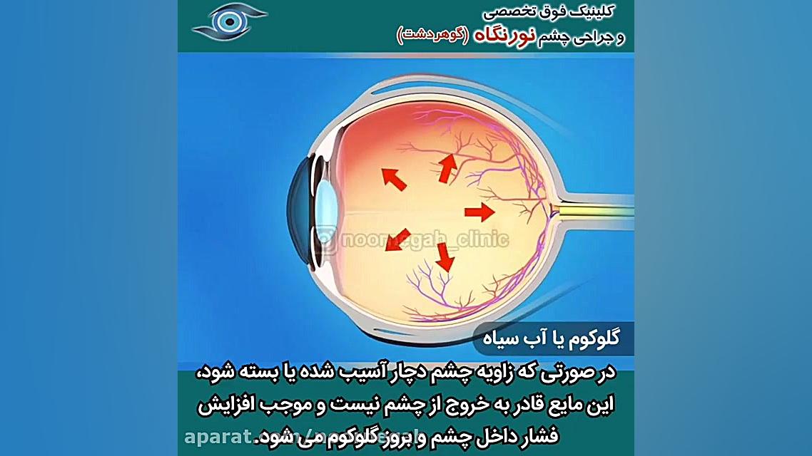 گلوکوم یا آب سیاه ابرسانی پوست