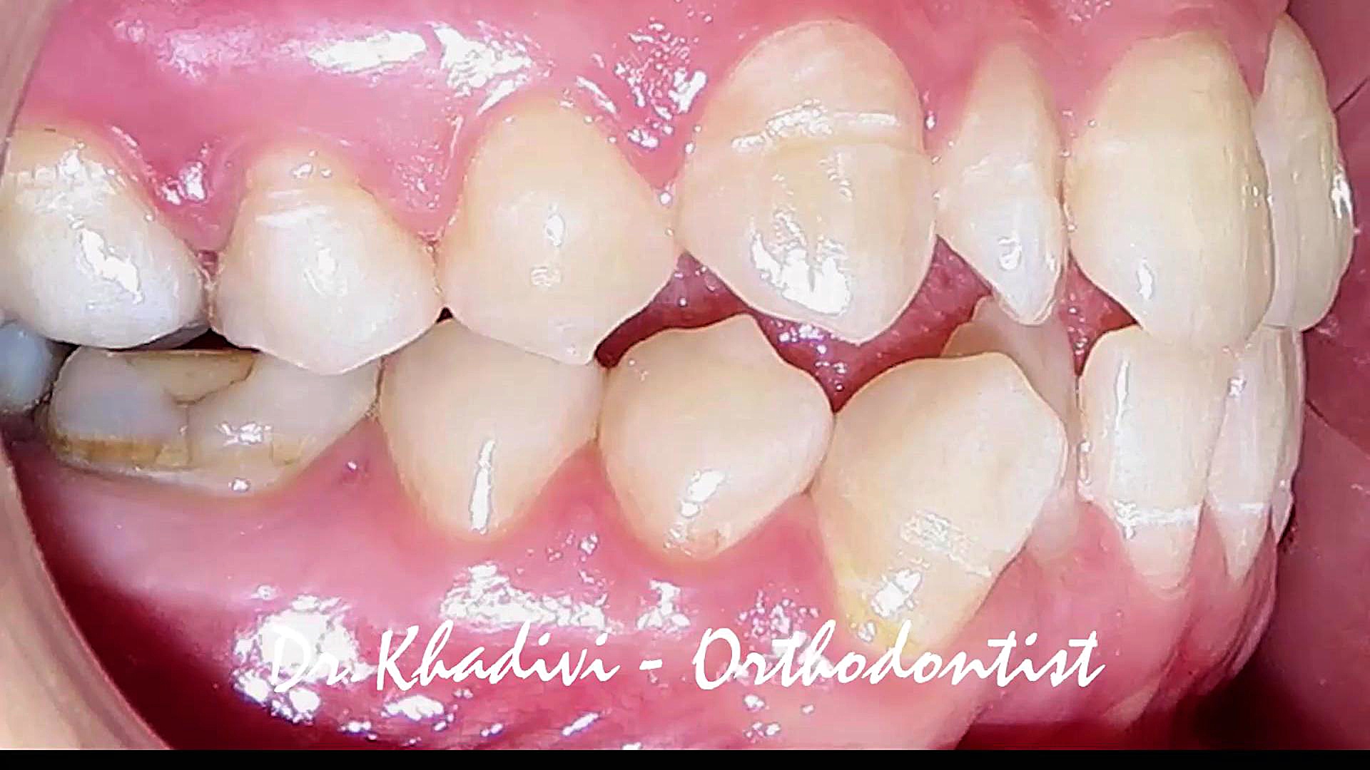 ارتودنسی بدون کشیدن دندان.متخصص ارتودنسی،دکترعلیرضاخدیوی دکتر علیرضا خدیوی