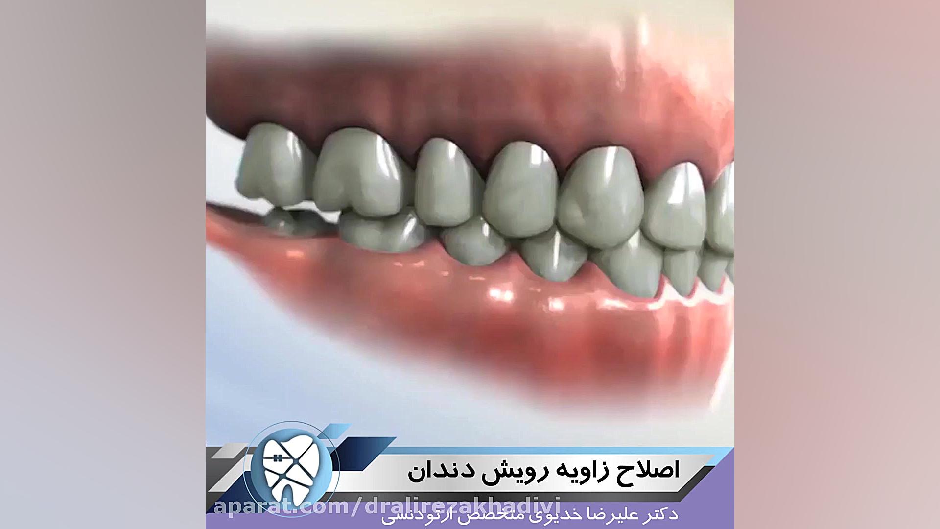 اصلاح زاویه رویش دندان،متخصص ارتودنسی،دکترعلیرضاخدیوی دکتر علیرضا خدیوی