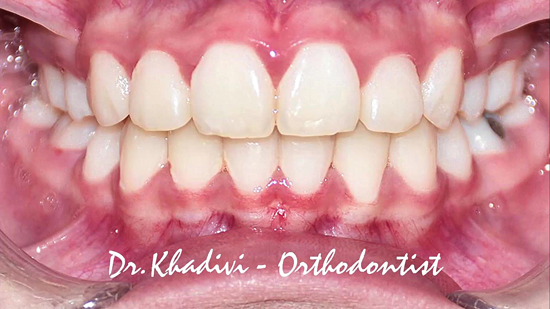 ارتودنسی با کشیدن دندان،متخصص ارتودنسی،دکترعلیرضاخدیوی دکتر علیرضا خدیوی