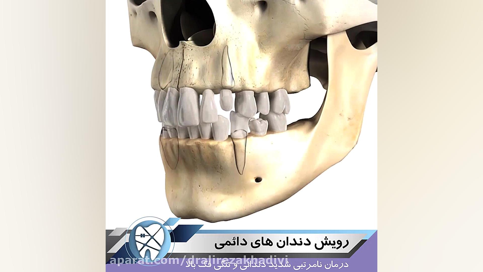 رویش دندان های دائمی،متخصص ارتودنسی،دکترعلیرضاخدیوی دکتر علیرضا خدیوی