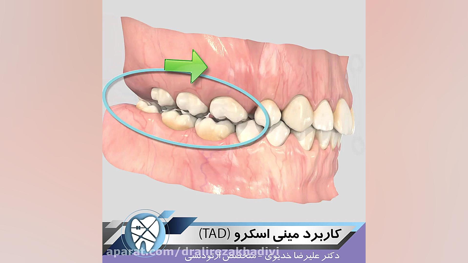 کاربرد مینی اسکرو،متخصص ارتودنسی،دکترعلیرضاخدیوی دکتر علیرضا خدیوی