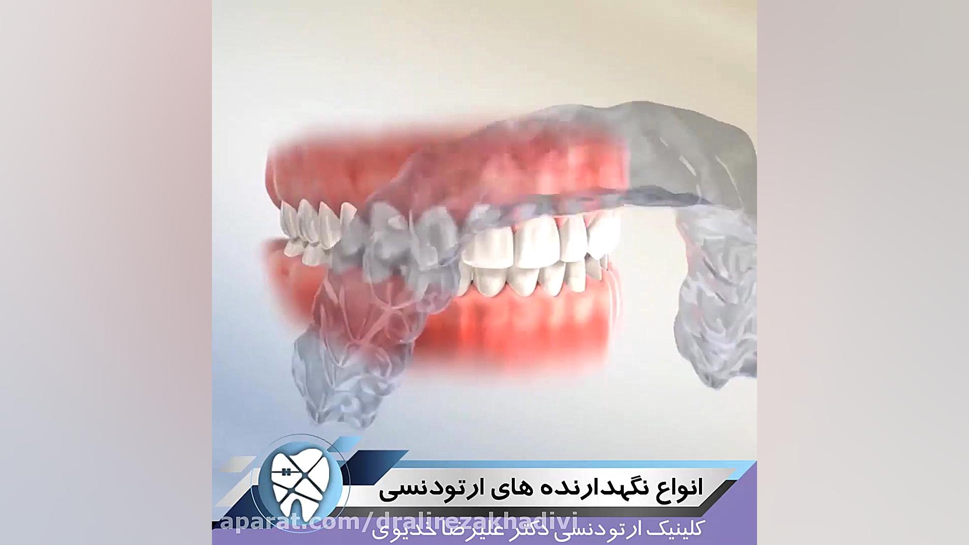 انواع نگه دارنده های ارتودنسی،متخصص ارتودنسی،دکترعلیرضاخدیوی دکتر علیرضا خدیوی