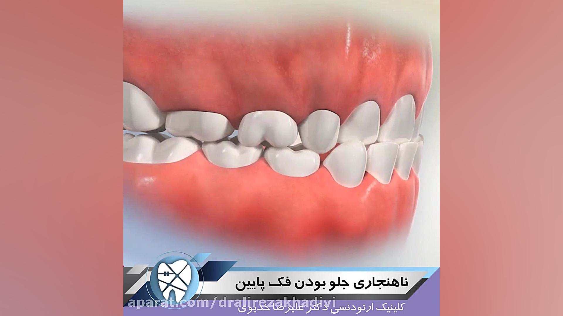 ناهنجاری جلوبودن فک پایین،متخصص ارتودنسی،دکترعلیرضاخدیوی دکتر علیرضا خدیوی